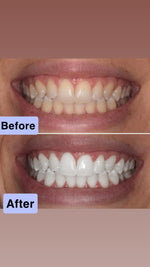 Load image into Gallery viewer, ✨ VEELANOO™ Smile Patches – Instant Teeth Whitening