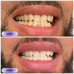 Load image into Gallery viewer, ✨ VEELANOO™ Smile Patches – Instant Teeth Whitening
